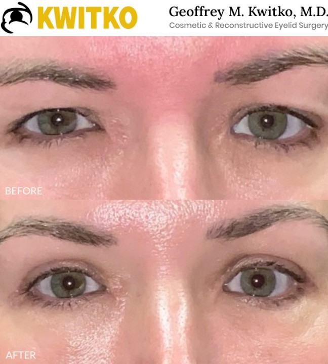 Upper Blepharoplasty