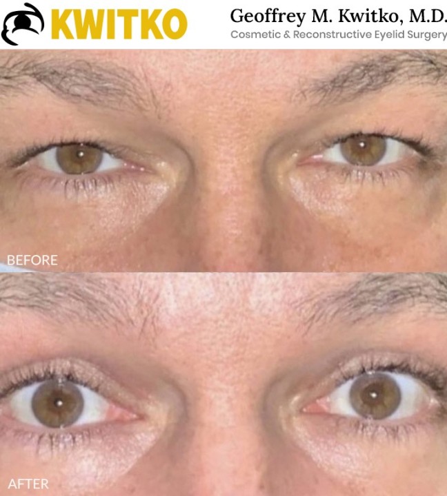 Upper Blepharoplasty
