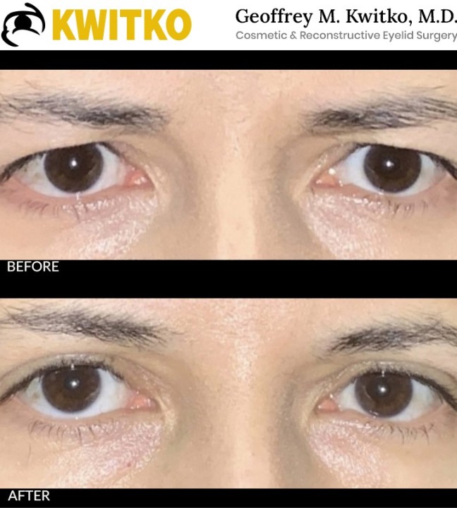 Upper Blepharoplasty