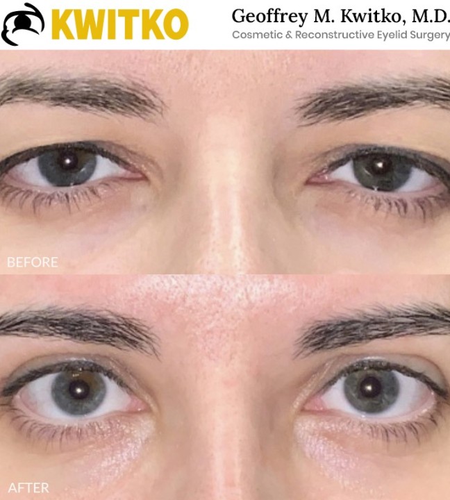 Upper Blepharoplasty