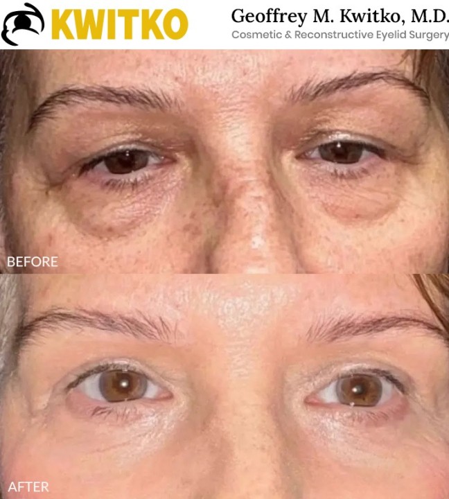 Upper Blepharoplasty