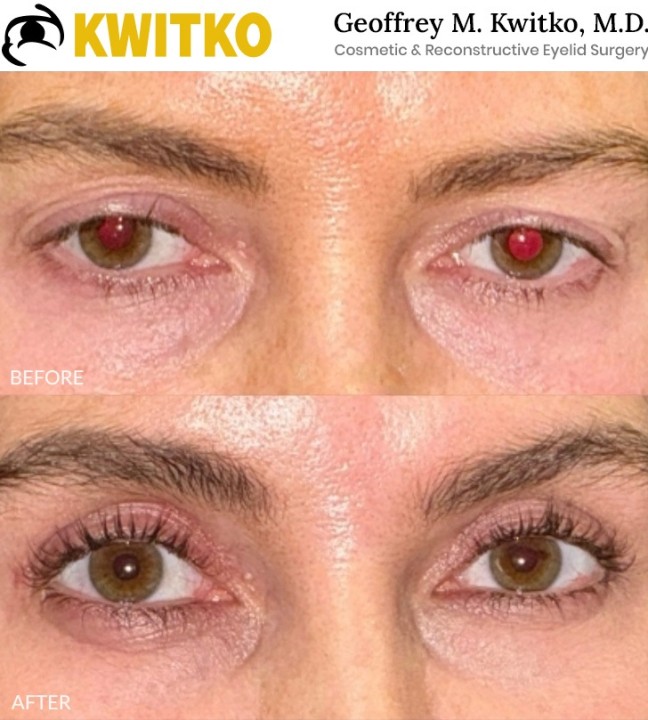 Upper Blepharoplasty