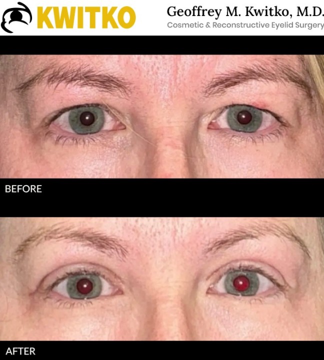 Upper Blepharoplasty