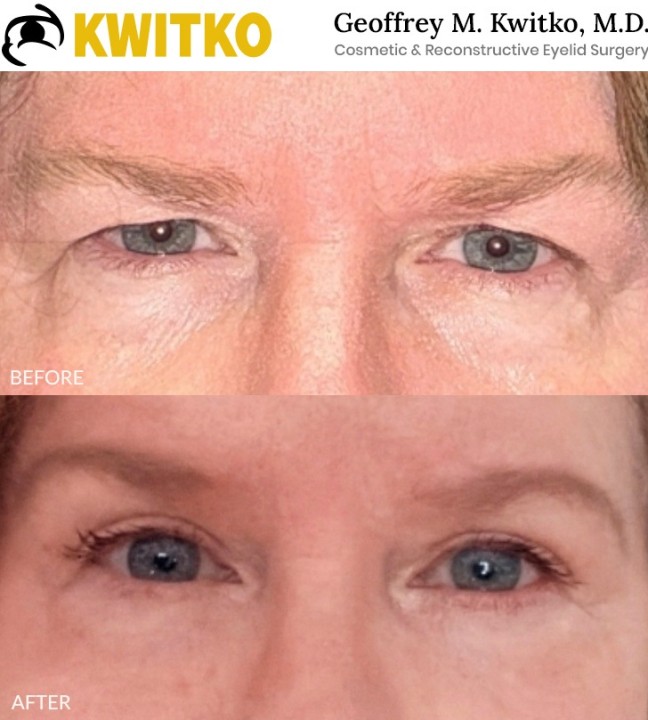 Upper Blepharoplasty
