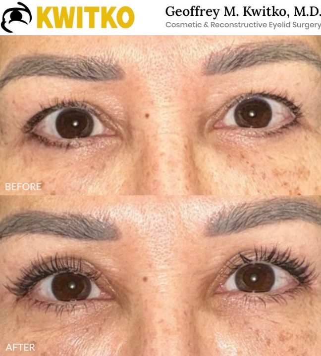 Upper Blepharoplasty