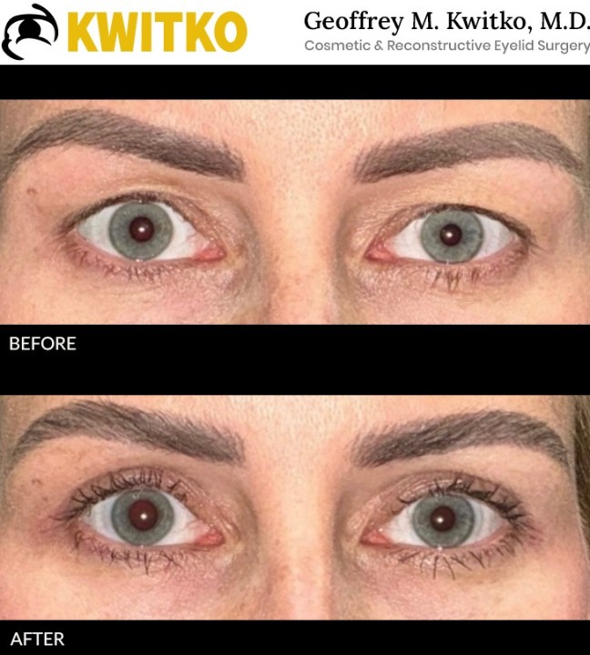 Upper Blepharoplasty