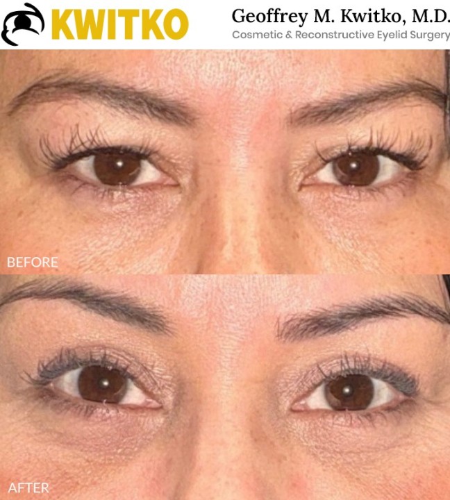 Upper Blepharoplasty