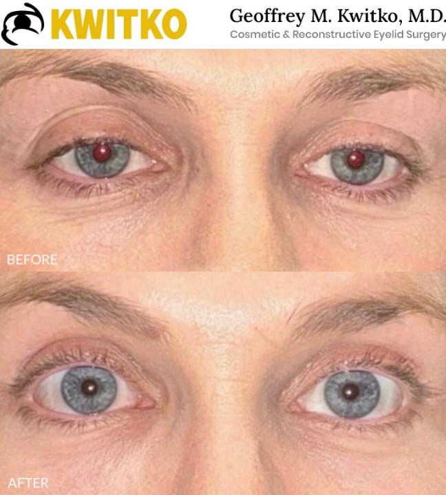 Upper Blepharoplasty