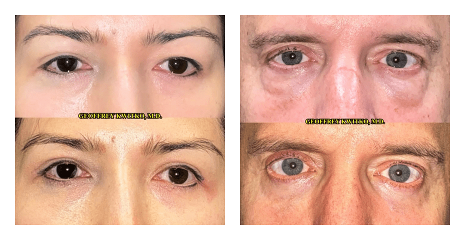 before after blepharoplasty patient