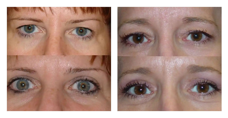 before after cosmetic eyelid surgery patient