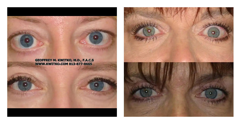 thyroid eye disease before and after