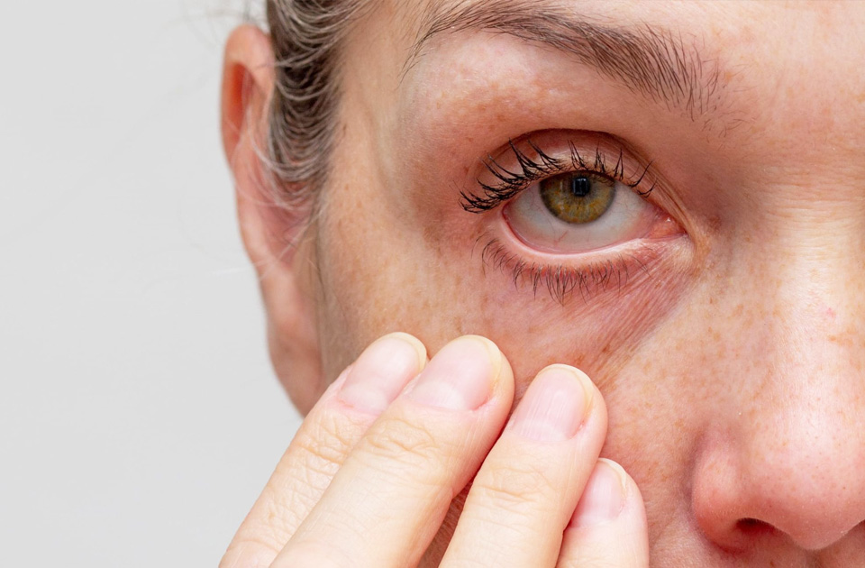 Cropped woman face with fingers under eye showing redness in eye