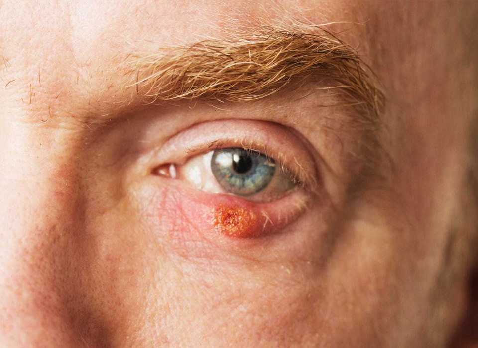 Man's lower eyelid has a blocked sebaceous gland