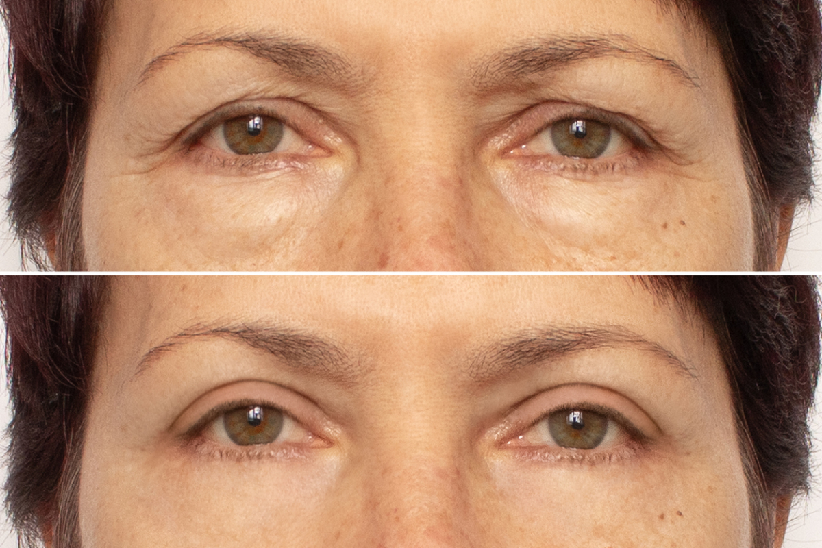 Featured image for Will Insurance Pay for Eyelid Surgery?